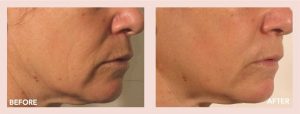 Facelift results
