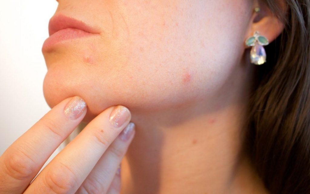 The Ins And Outs Of Adult Acne And How To Fight It