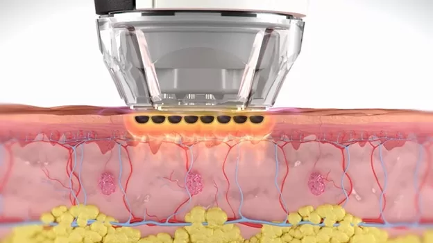 Illustration of skin rejuvenation