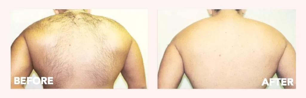 Laser Hair Removal